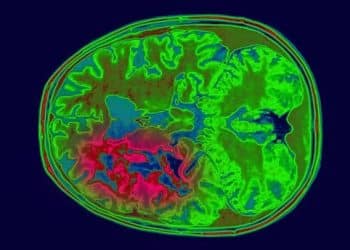 CBD and THC Synergism and Glioblastoma