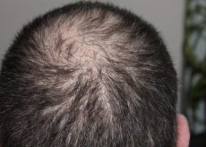 Hair Regrowth with Cannabidiol (CBD)