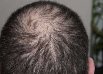 Hair Regrowth with Cannabidiol (CBD)