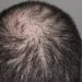 Hair Regrowth with Cannabidiol (CBD)